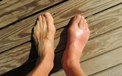 Foot Gouts - Chiropractic